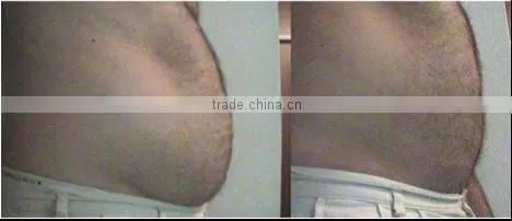 Vacuum Cavitation RF Crylipolysis Equipment o-F1