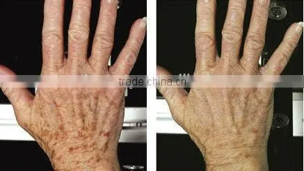 High power professional ipl photo rejuvenation machine