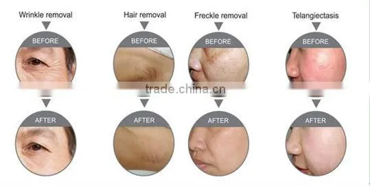 Best selling! ipl skin rejuvenation system