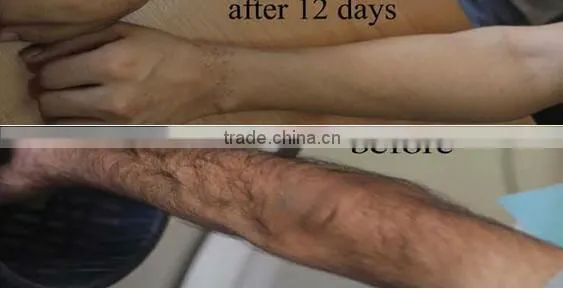 Korea technology! 2016 Newest smart ipl diode laser hair removal machine price