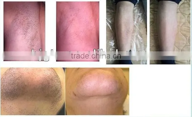 GI-13 portable one crystal hand IPL hair removal and skin care with best price