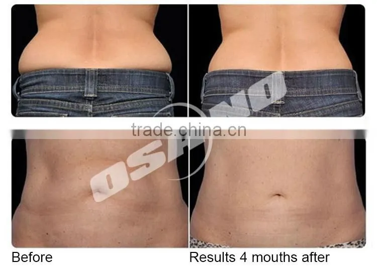 Mini home usre Lipo Laser Machine lipo laser deivce