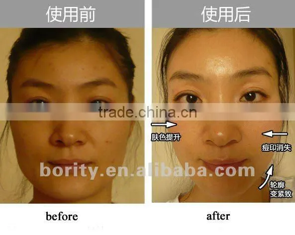 Best Sale Portable Facial Diamond Peel Machine for sale on 2016