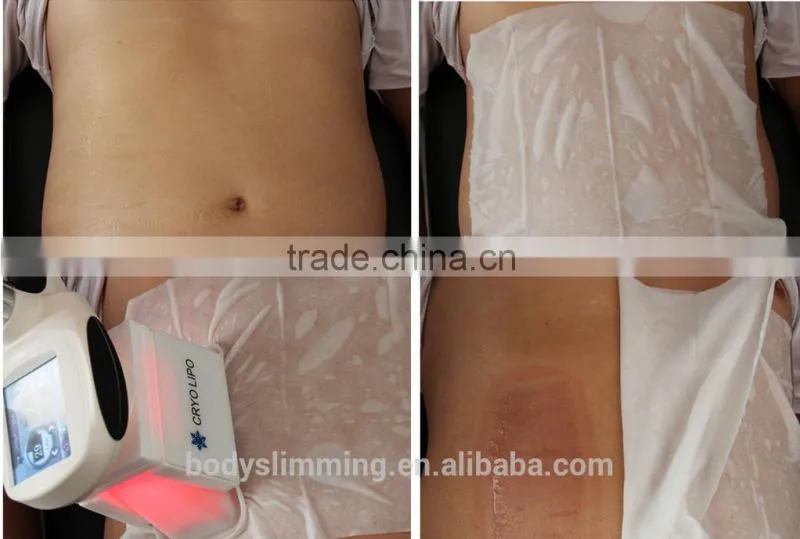 Cryolipolysis & Vacuum Roller Massage & Laser Pad & Cavitation RF Weight Loss Machine CE Approved