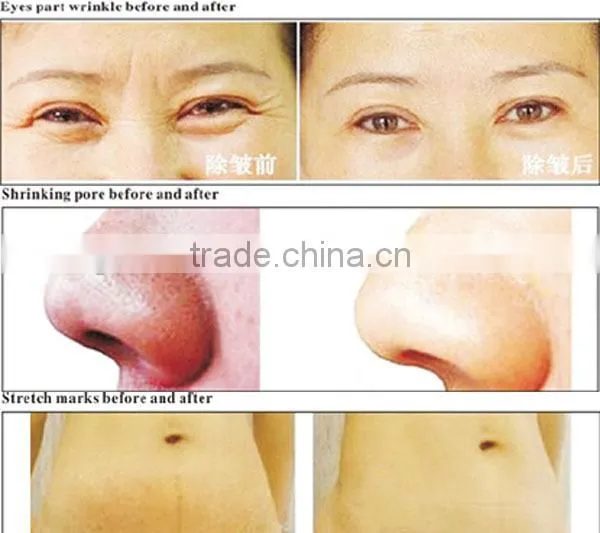 wholesale factory direct top rated titanium 192 cheap derma roller for scars/pores/acne removal
