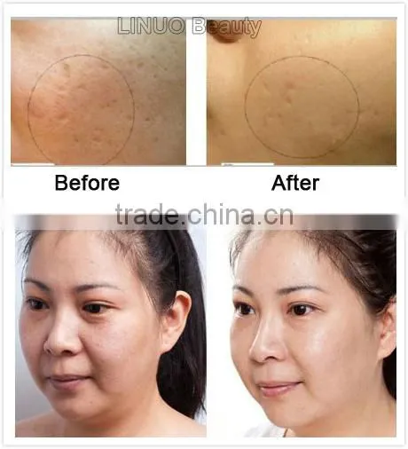 derma clean medical needles for acne treatment