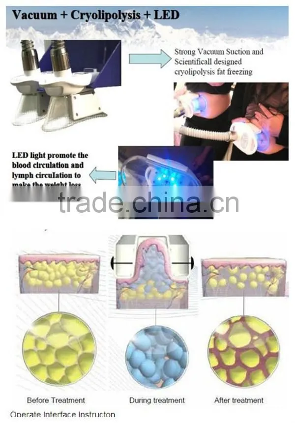 Cavitation Vacuum RF Body Slimming Tripolar Radio Frequency Skin Tighten Machine