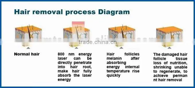 New products 2016 Permanent Ipl +808 nm diode laser hair removal machine/laser hair removal germany