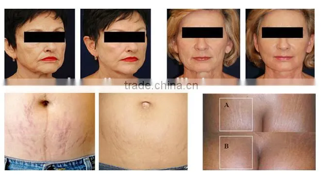 effective and moistening oxygen facial skin jet peel beauty machine