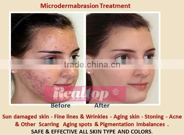 Distributor needed in usa 7in1 diamond tip microdermabrasion skin peel machine peeling facial cleaner equipment