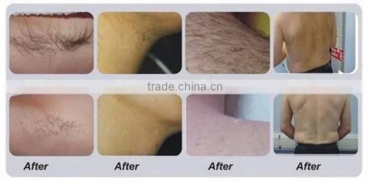 Good effective laser hair removal equipment of jmshr 808