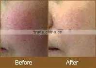 2016 hottest laser hair removal machine 1064nm Laser Hair Removal machine P001