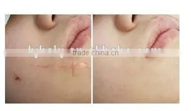 new hot professional Rhytidectomy Fraction new face dead skin remove