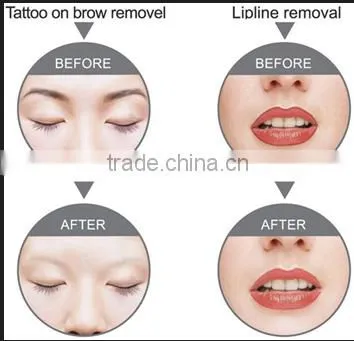 E6 2016 painless IPL/E-light laser hair removal machine
