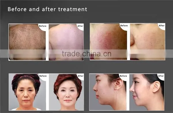 Hot Sale 3 in1 Q-switch E Light Rf+ipl Hair Removal Yag Laser Tattoo Removal Beauty Machine