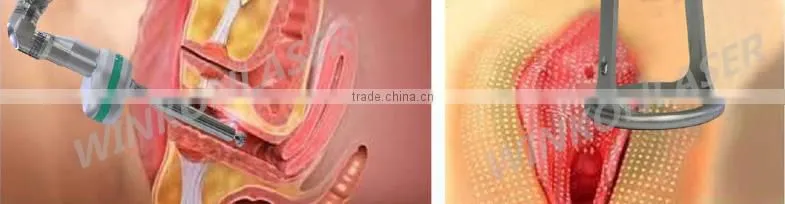 Factory price! Professional doctor use CO2 vaginal laser not only vaginal lifting but also face lift