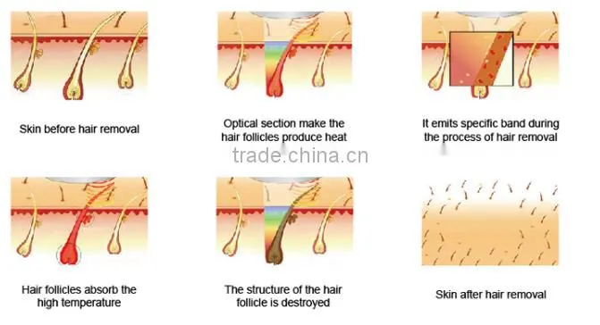 Dark skin 808/755/1064nm combination Permanent Hair Removal Laser Diode machine for Clinic