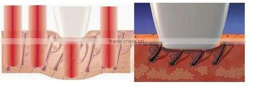 Vertical First Class Technology 808nm Diode Laser Permanent Epilation Machine