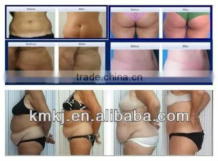 Super 4s tripolar rf machine for face lifting with cavitation system (CE,ISO,SGS,BV)