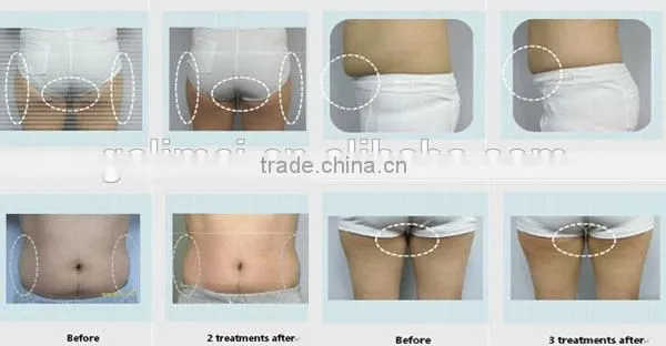 2015 ce approved 5 in 1 cavitation ultrasonic lipolysis slimming machines