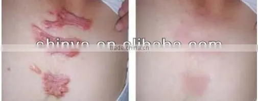 epidermis transplantation vitiligo machine