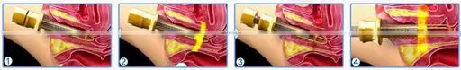 Merry christmas biggest discount! GGLT 30w CO2 Fractional laser vaginal rejuvenation machine