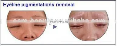 beauty studio nd yag laser tattoo removal treatment head machine D006