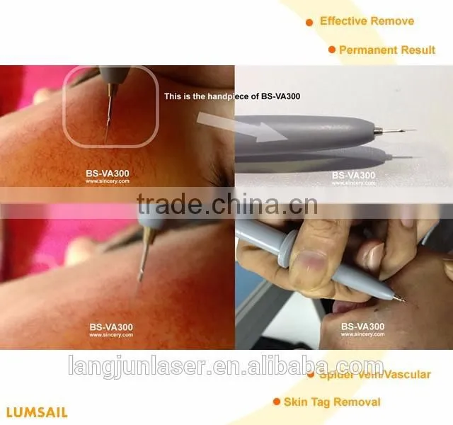 Spider Vein Removal/Vascular Removal