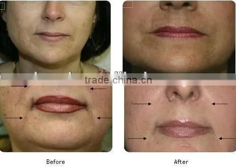 100% High Quality Skin Resurfacing Acne Scar Removal Fractional Co2 Laser Equipment