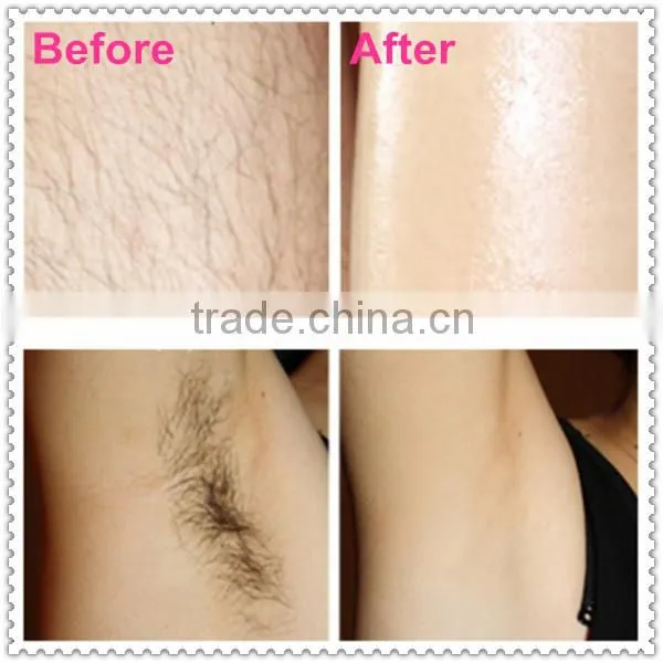 Professional shr ipl hair removal machine