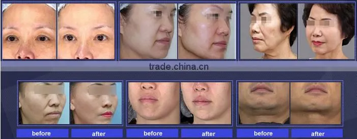 Professional hifu machine ultrasound machine in germany for face lift and wrinkle removal