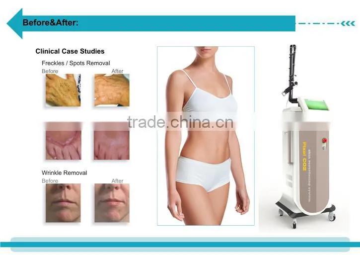 Portable CO2 Laser Fractional Pixel Vaginal Laser Tightening