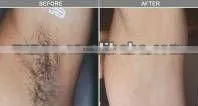 Hot Sale in 2014 IPL&RF hair removal machine