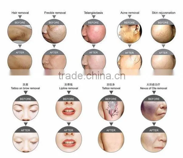 multifunctional laser and IPL body hair removal machine for sale (multifunction facial beauty machine)