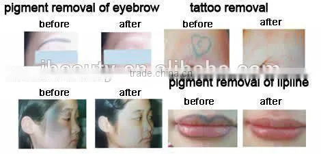ipl rf nd yag laser hair removal machine/elight with ce/home use ipl