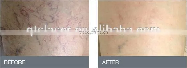 QTS 2016 Blood Vessels spider veins Removal ,with 980nm wavelength laser