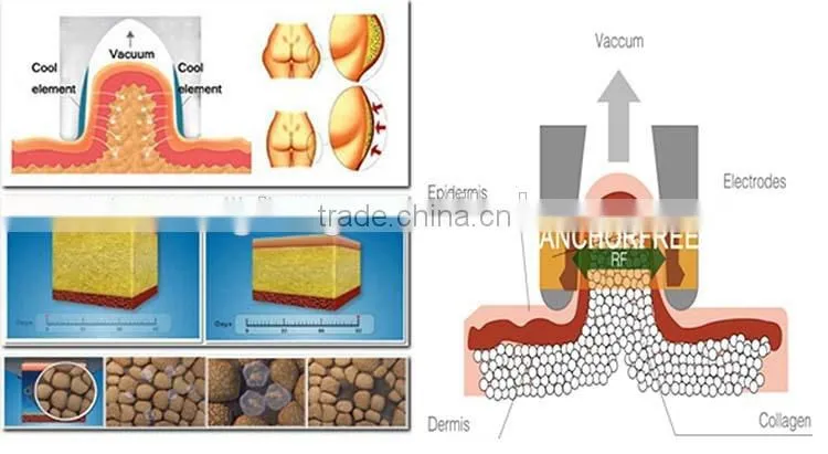 body fat analysis vacuum treatment head slimming machine