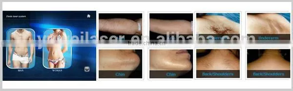 Factory Direct 808nm diode tria laser hair removal 4x