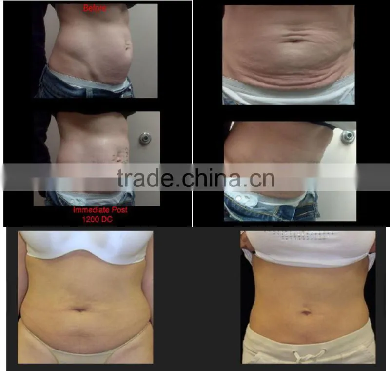 NL-TM804 Fractional Thermagic RF Machine CPT skin rejuvenation machine