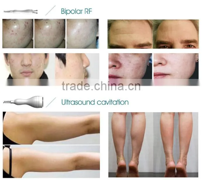 sanhe hifu body shaping fat removal slimming machine/Hifu slimming