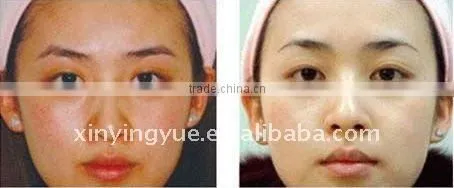 professional yag laser tattoo removal skin scar removal