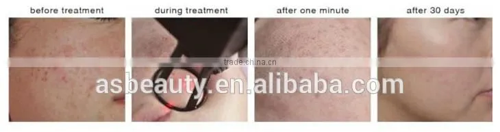 Hottest selling laser co2 /medical fractional co2 laser machine