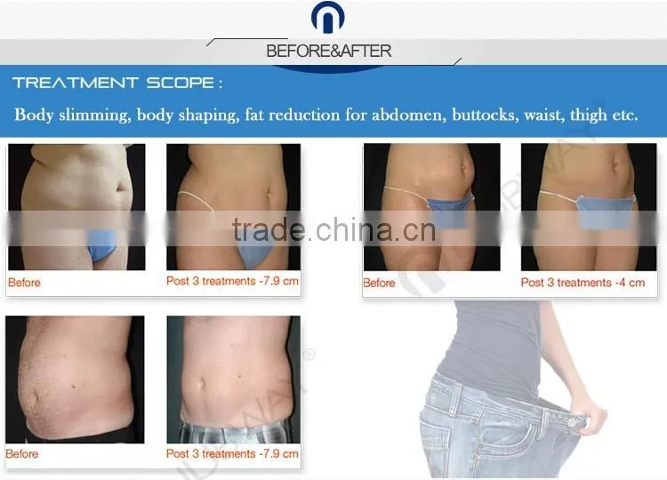 Hifu loss weight slimming lipo laser machine, ultrasound machine price, beauty salon equipment