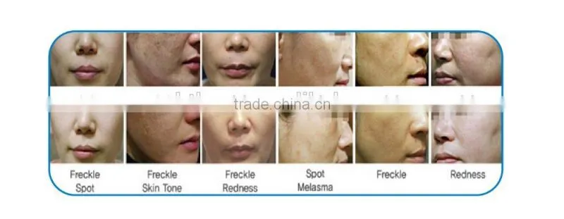 2015 Protable Laser fractional Co2 laser treatment acne scars and vaginal tightening machine