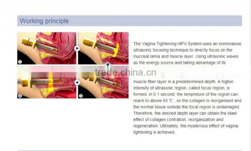 China 2016 new products ! Professional Female Private Care Hifu Vaginal Tightening Machine with Presice Depth Adjustment System