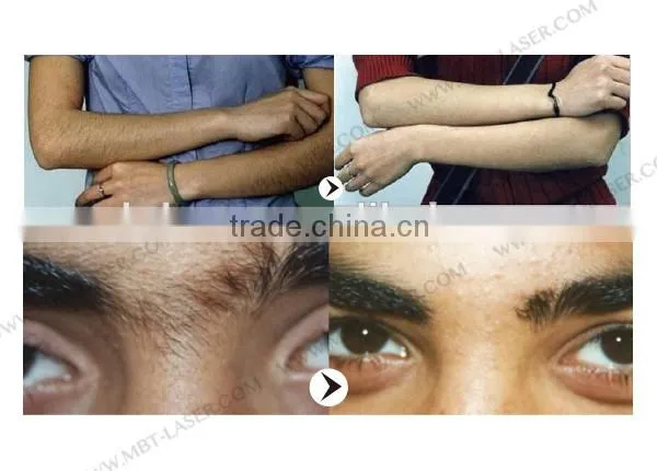 CE/GOST-P approved Wireless Diode laser system Dental Laser Equipment / Diode Laser 808nm hair removal