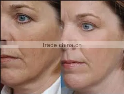Skin younger oxygen skin refreash machine