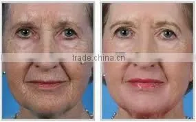 Distributors wanted Medical Q-switche laser 1064nm ND YAG home alexandrite laser hair removal machine