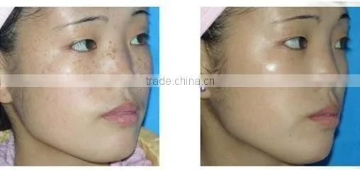 portable Laser spot removal pen/freckle removal pen/mole removal machine for HOT SALE