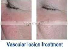 hot selling ipl age spots pigmentation hair removal machine ipl flash lamp rf nd yag laser machine for hair removal